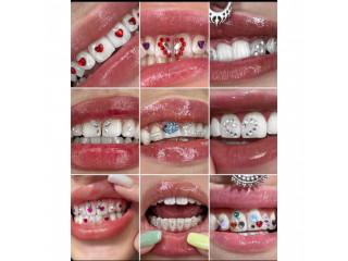 Different types of teeth gem stones design in kampala near me