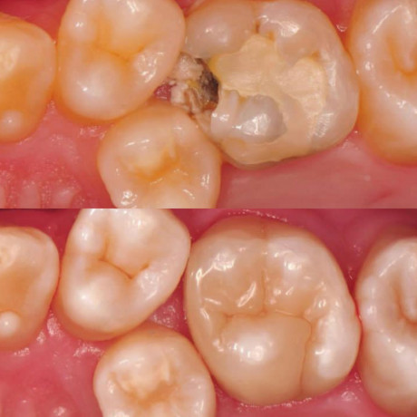 teeth-composite-restoration-in-kampala-near-me-big-0