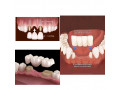 dental-solutions-kampala-small-0