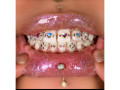 teeth-gems-in-kampala-small-1