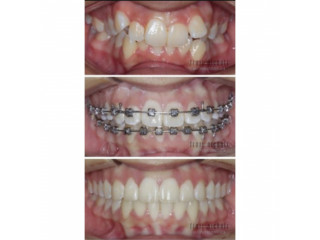 Teeth braces in kampala