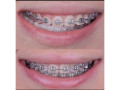 dental-braces-in-kampala-small-0