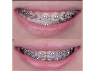 Dental braces in kampala