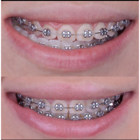 dental-braces-in-kampala-big-0