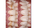 fluoride-affected-teeth-treatment-in-kampala-small-0