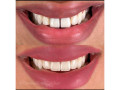 diastema-closure-with-crowns-in-kampala-small-0