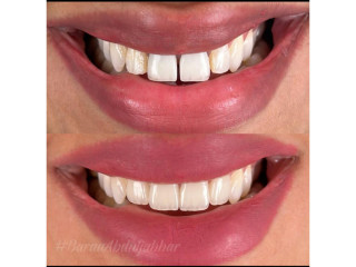 Diastema closure with crowns in kampala