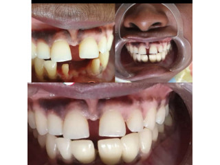 Teeth replacement in Kampala