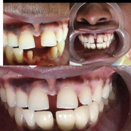 teeth-replacement-in-kampala-big-0