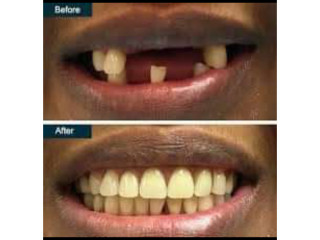 Artificial teeth replacement in Kampala