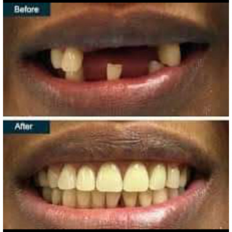 artificial-teeth-replacement-in-kampala-big-0