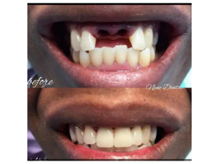 Permanent teeth replacement in Kampala