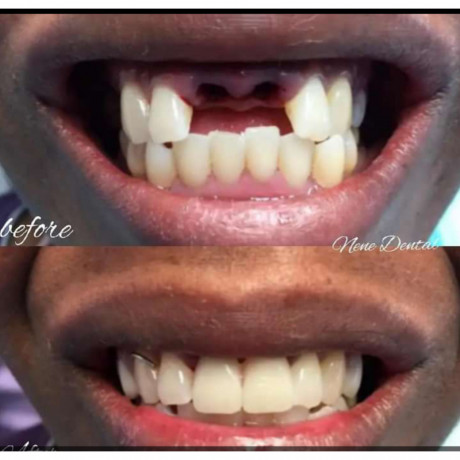 permanent-teeth-replacement-in-kampala-big-0