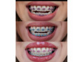 braces-treatment-in-kampala-small-0