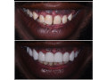 teeth-gaps-closure-with-crowns-small-0