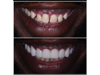 Teeth gaps closure with crowns