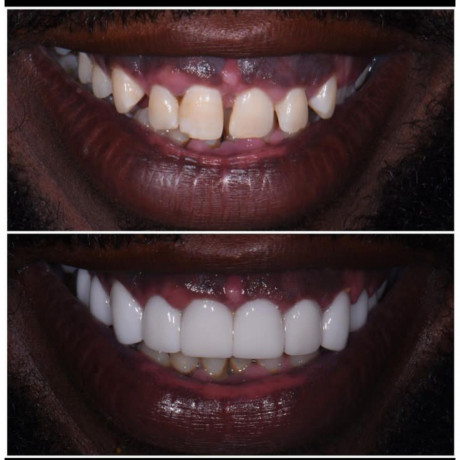 teeth-gaps-closure-with-crowns-big-0