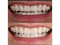 short-teeth-crown-lengthening-with-crowns-in-kampala-small-0