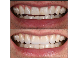 Short teeth crown lengthening with crowns in kampala