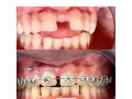 gap-teeth-closure-with-braces-in-kampala-small-0