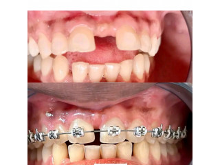 Gap teeth closure with braces in kampala