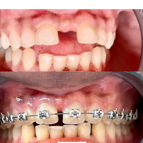 gap-teeth-closure-with-braces-in-kampala-big-0