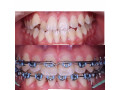 teeth-alignment-with-braces-in-kampala-small-0