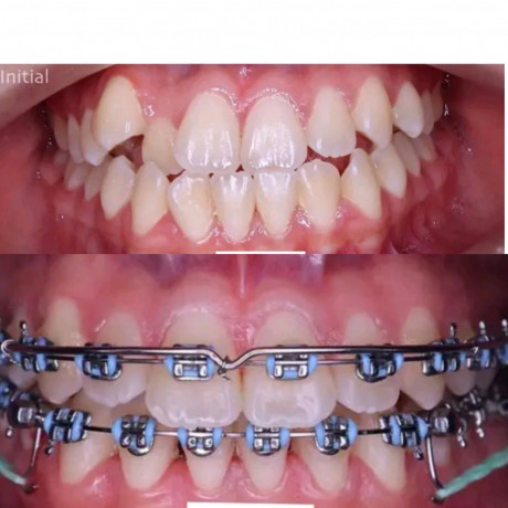 teeth-alignment-with-braces-in-kampala-big-0