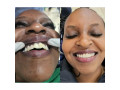 teeth-alignment-with-crowns-in-kampala-uganda-small-0