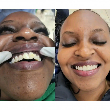 teeth-alignment-with-crowns-in-kampala-uganda-big-0