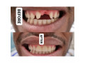 dental-bridge-for-teeth-replacement-in-kampala-small-0