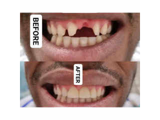 Dental bridge for teeth replacement in Kampala