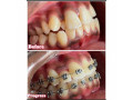 crowded-teeth-braces-treatment-in-kampala-small-1