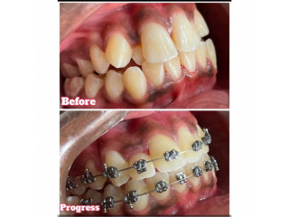 Crowded teeth braces treatment in Kampala