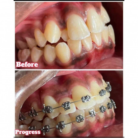 crowded-teeth-braces-treatment-in-kampala-big-1