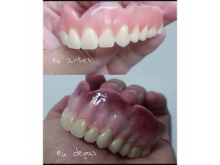 Dentures in kampala