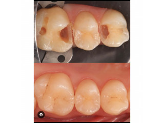 Teeth cavity cementing in kampala