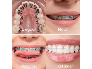 Different types of braces at Dental solutions Kampala