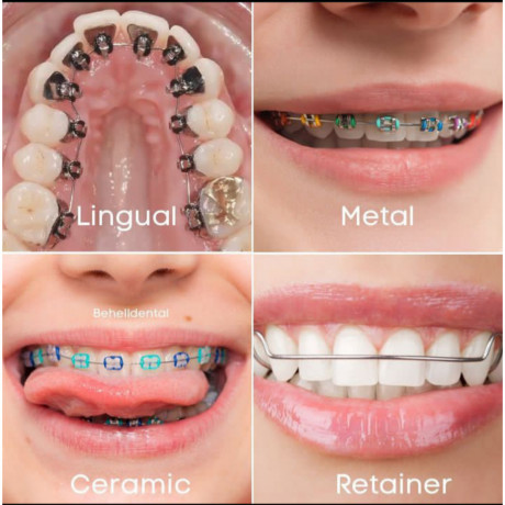 different-types-of-braces-at-dental-solutions-kampala-big-0