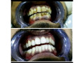 teeth-cleaning-in-kampala-small-0