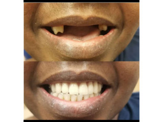 Teeth replacement with a dental bridge in kampala Uganda