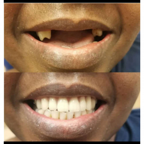 teeth-replacement-with-a-dental-bridge-in-kampala-uganda-big-0