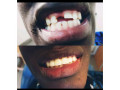 replacement-of-teeth-in-kampala-small-0