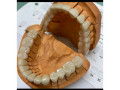 artificial-teeth-fabrication-in-kampala-small-0