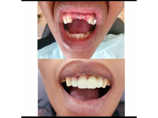 Dental bridge for permanent teeth replacement in Kampala