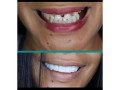 smile-perfection-with-teeth-veneers-and-crowns-in-kampala-small-0