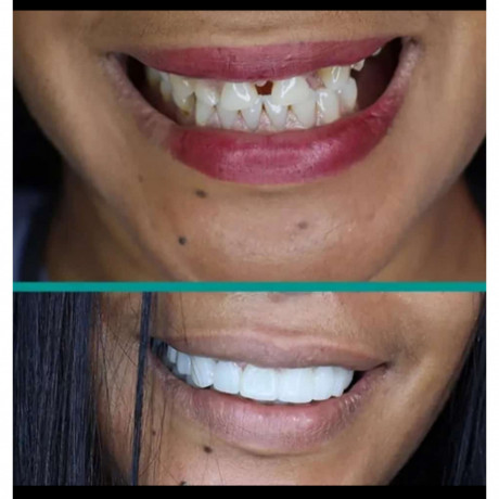 smile-perfection-with-teeth-veneers-and-crowns-in-kampala-big-0