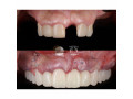 teeth-replacement-with-dental-solutions-in-kampala-small-0