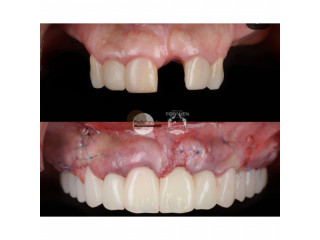 Teeth replacement with dental solutions in kampala