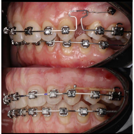 teeth-alignment-with-braces-in-kampala-uganda-big-0